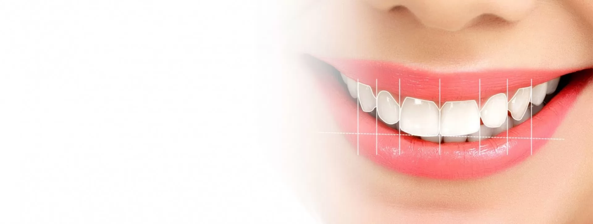 Gülüş tasarım uygulamaları