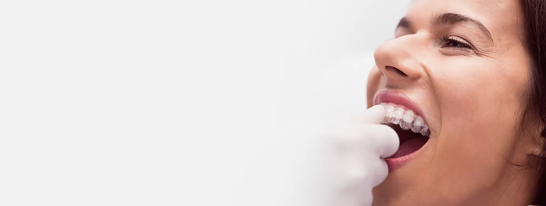 Clear Alignment (Braces) Treatment